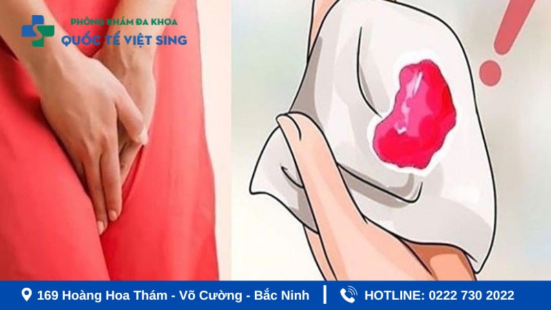 Dấu hiệu viêm phụ khoa nặng - Chị em cần cảnh giác