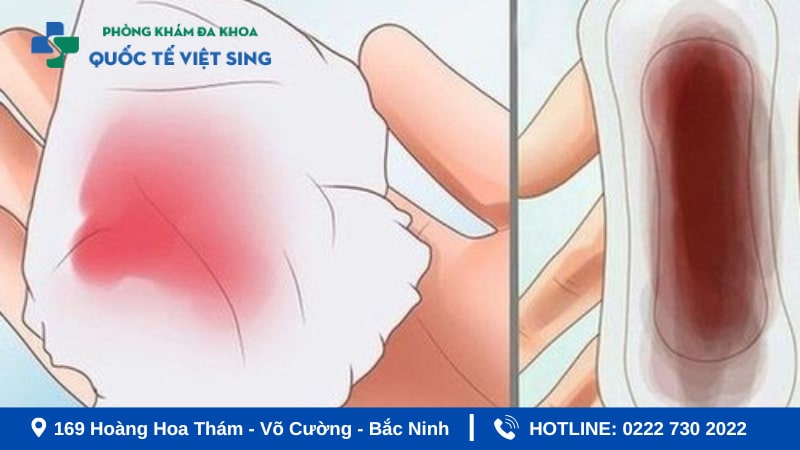 Hình ảnh rối loạn kinh nguyệt