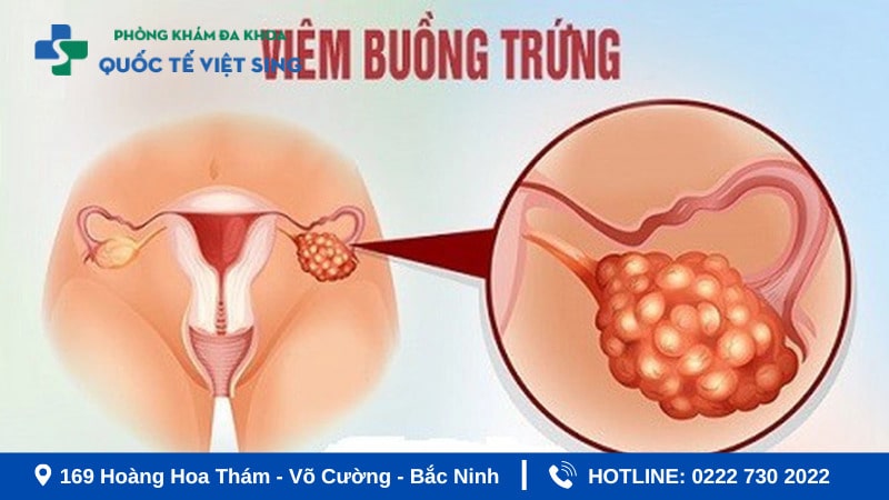 Hình ảnh viêm buồng trứng