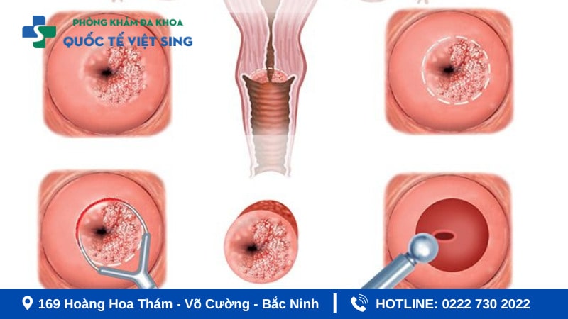 Hình ảnh viêm lộ tuyến cổ tử cung