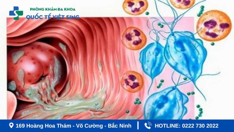 Hình ảnh viêm nhiễm phụ khoa do ký sinh trùng
