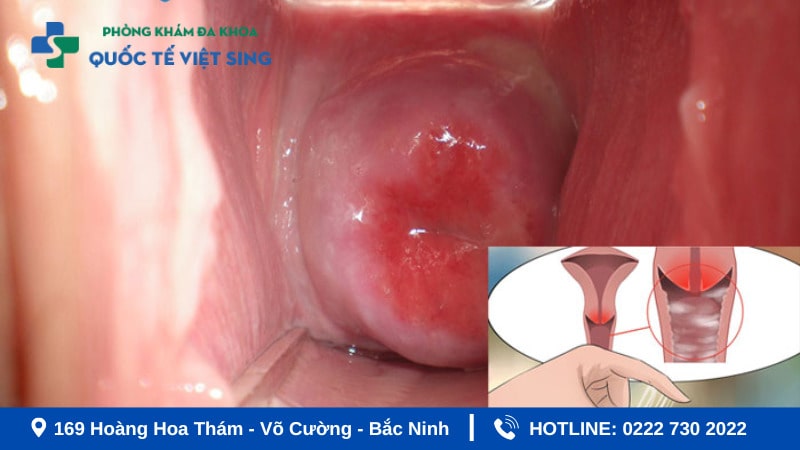 Hình ảnh viêm nhiêm phụ khoa do bệnh lậu