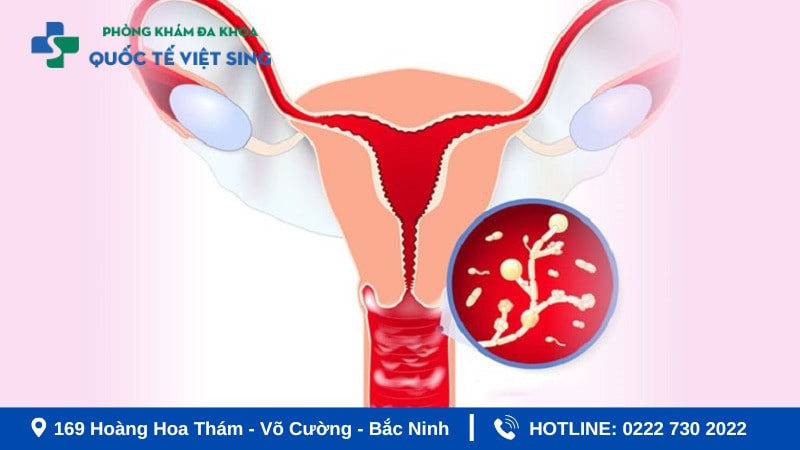 Hình ảnh viêm nhiễm phụ khoa ở vùng chậu
