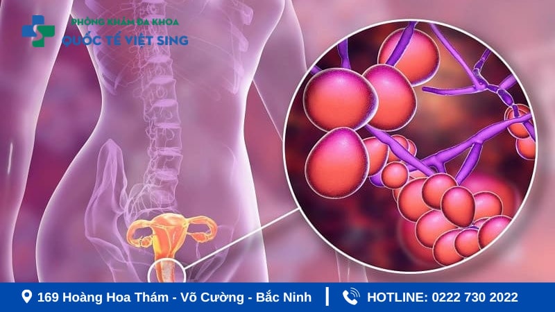 Viêm âm nhiễm phụ khoa do vi khuẩn