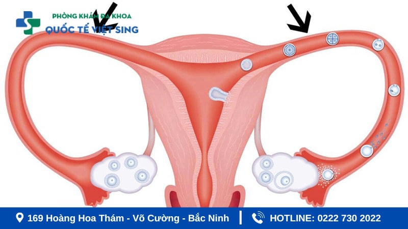 Hình ảnh viêm ống dẫn trứng