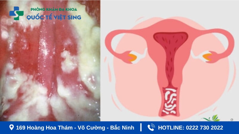 Hình ảnh viêm phụ khoa do nấm Candida