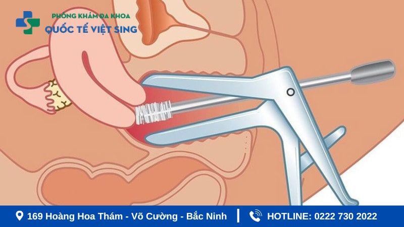 Khám phụ khoa bằng mỏ vịt có đau không? 