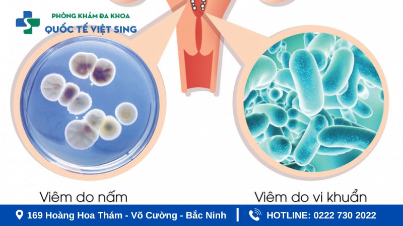 Nguyên nhân gây bệnh viêm nhiễm phụ khoa