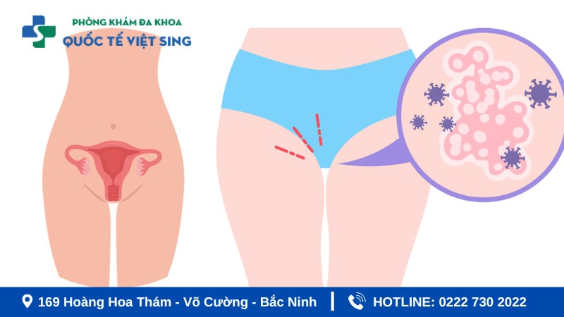Nguyên nhân viêm phụ khoa thường gặp