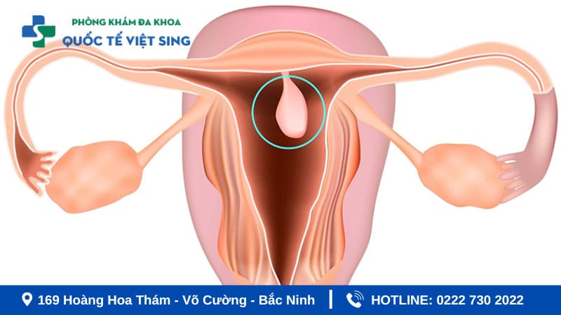 Polyh tử cung bệnh phụ khoa thường gặp ở nữ giới