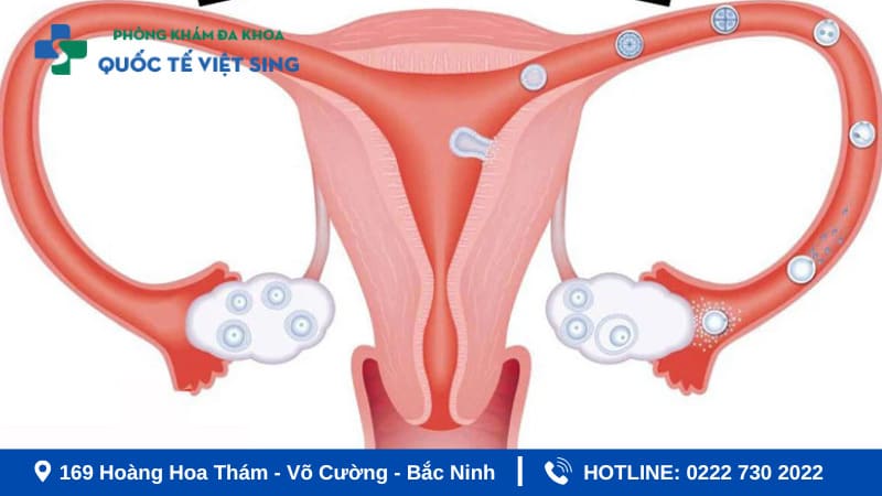 Tắc vòi trứng là một trong các bệnh phụ khoa thường gặp
