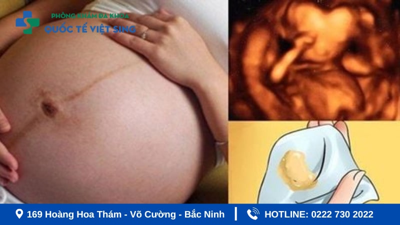 Dấu hiệu viêm phụ khoa khi mang thai 3 tháng cuối