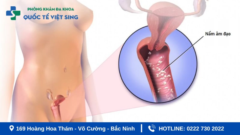 Dấu hiệu và triệu chứng viêm âm đạo do nấm 
