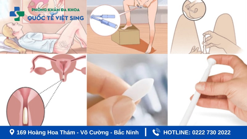 ướng dẫn đặt thuốc viêm phụ khoa đúng cách tại nhà