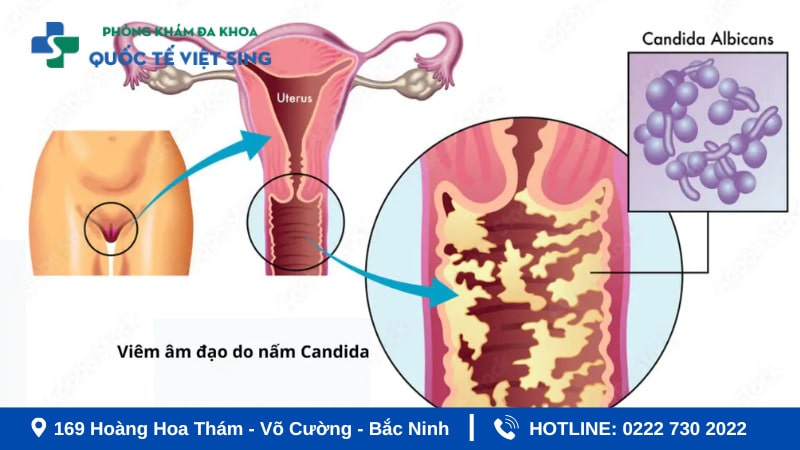 Nguyên nhân gây viêm âm đạo? Có nguy hiểm không