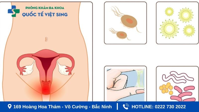 Tác nhân gây viêm phụ khoa khi mang thai