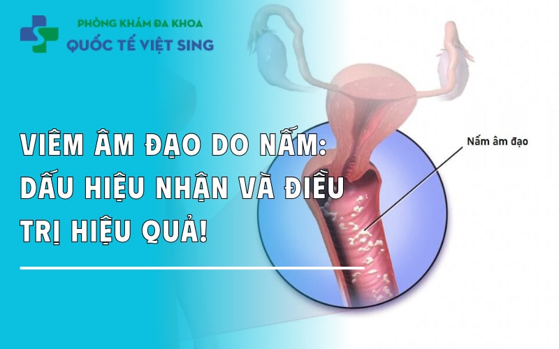 Viêm âm đạo do nấm: Dấu hiệu nhận và cách điều trị hiệu quả