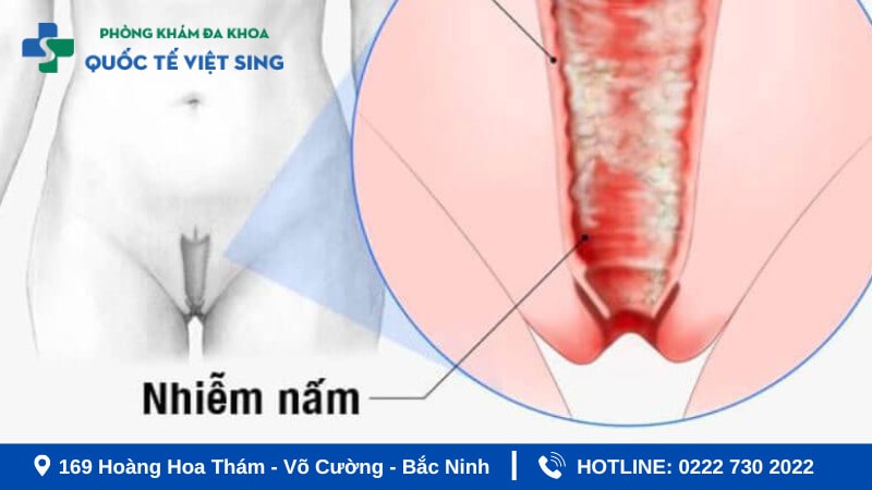 Viêm âm đạo do nấm là gì?
