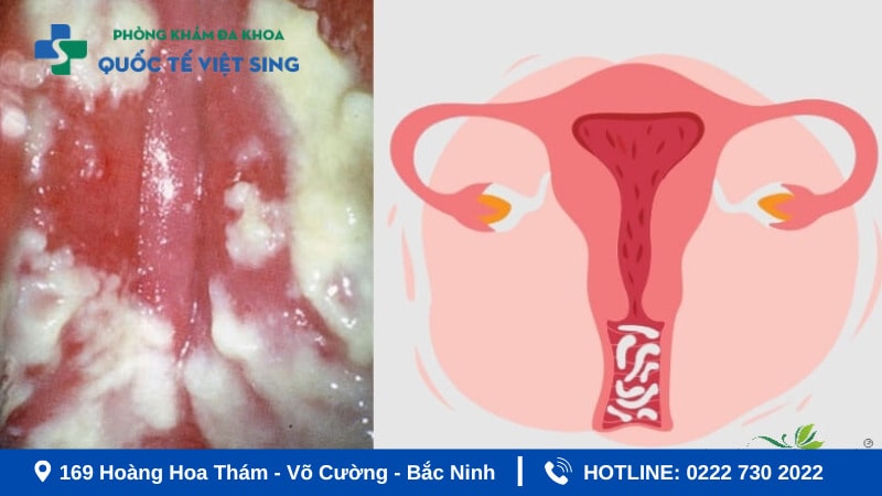 Viêm âm đạo là gì? Dấu hiệu nhân biết âm đạo bị viêm 