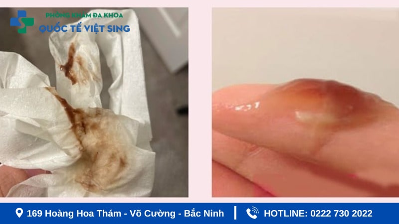 Dấu hiệu sắp tới kỳ kinh hoặc sau kỳ kinh