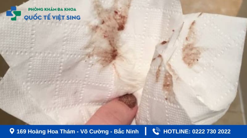 Nguyên nhân ra khí hư màu nâu trước kỳ kinh nguyệt