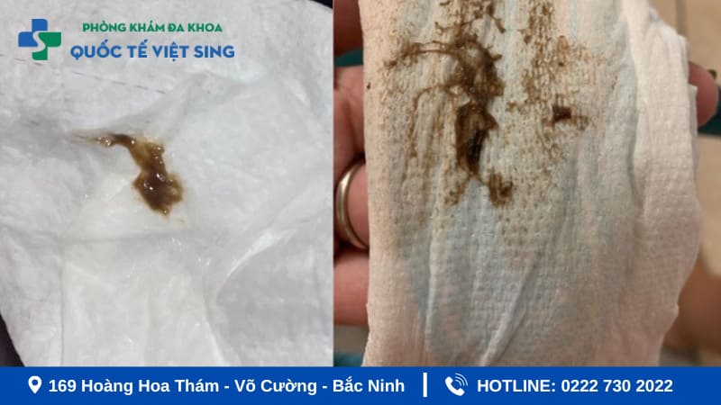 Ra khí hư màu nâu trước kỳ kinh nguyệt là gì?