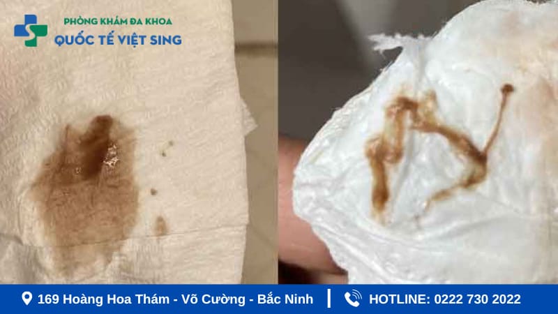 Ra khí hư màu nâu trước kỳ kinh có nguy hiểm không?