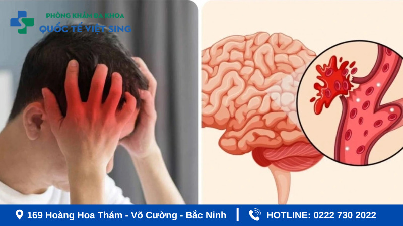 Dấu hiệu nhận biết hiện tượng tai biến nhẹ