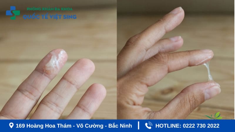 Khi nào khí hư như lòng trắng trứng là dấu hiệu bệnh lý