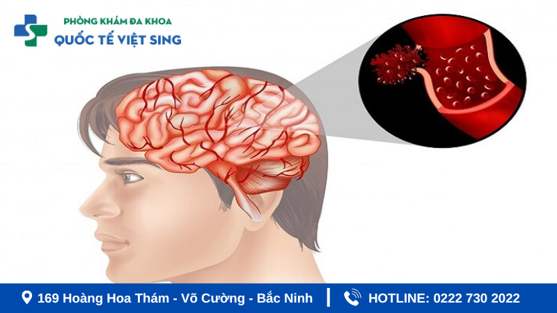 Tìm hiểu tai biến mạch máu não là gì?