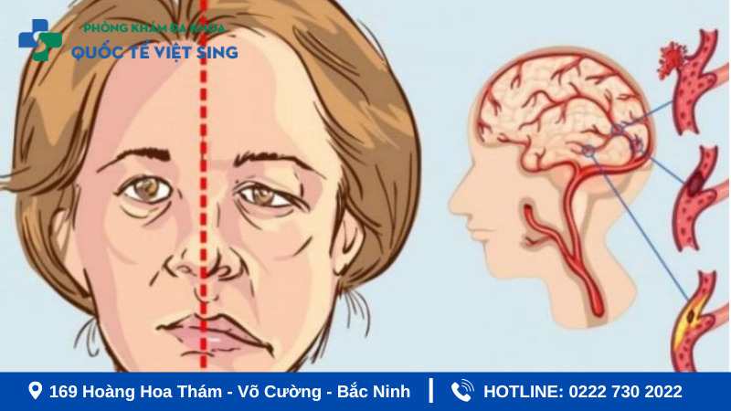 Tai biến mạch máu não nguy hiểm như thế nào?