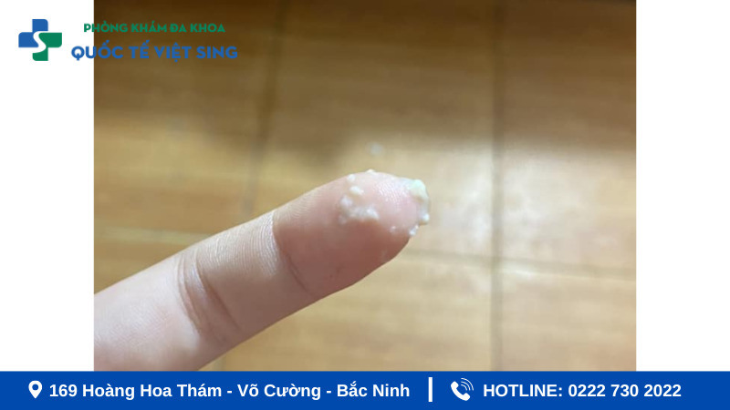 Khí hư dạng bột trắng không mùi là gì?