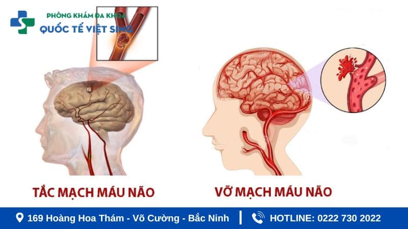 Phân loại các loại tai biến (đột quỵ) phổ biến