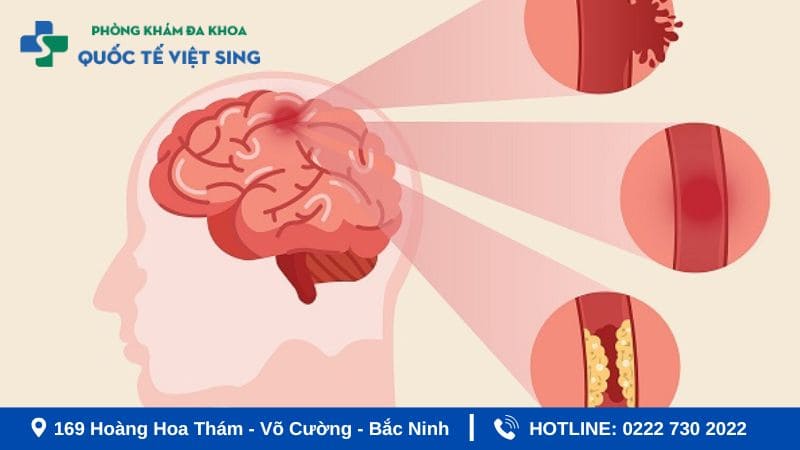 Tai biến mạch máu não là gì?
