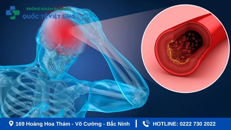 Tai biến và đột quỵ có giống nhau không?