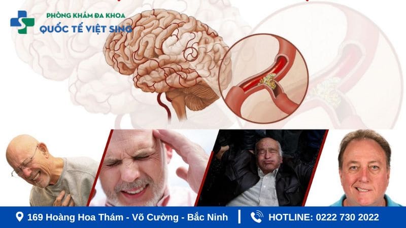 Tầm quan trọng của cấp cứu tai biến giờ vàng